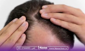 راه های جلوگیری از ریزش مو